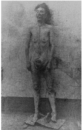 Fotografía del cadáver de Catherine Eddowes (1842-1888), víctima canónica de Jack el Destripador en la morgue, tras el examen médico del cuerpo. Como puede verse, en este caso el interés estético ha desaparecido por completo, siendo la finalidad de la toma meramente informativo (Royal
London Hospital Archives and Museum, Londres, Reino Unido).